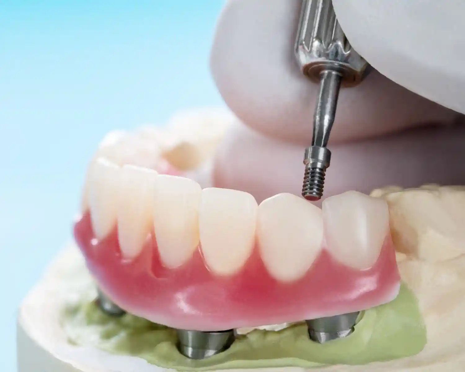 Diş modeli üzerinde All-on-6 implant sistemiyle sabit diş protezi planlaması